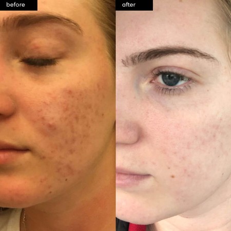slmd acne system