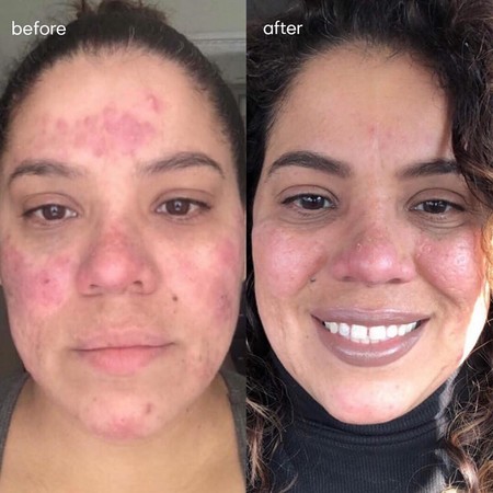 slmd acne reviews